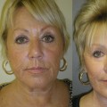 The Truth About Plastic Surgery Recovery: An Expert's Perspective