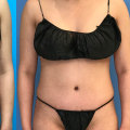 Liposuction vs Tummy Tuck: Which is More Painful?