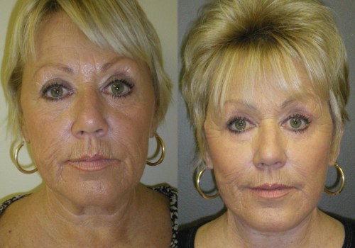 The Truth About Plastic Surgery Recovery: An Expert's Perspective