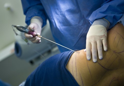 The Rise of Caesarean Sections: An Expert's Perspective