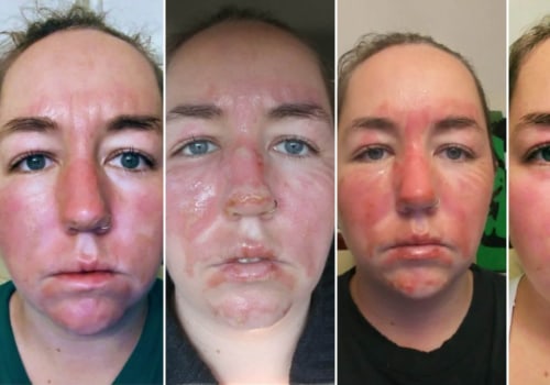 Healing Stages of 2nd Degree Burns Explained