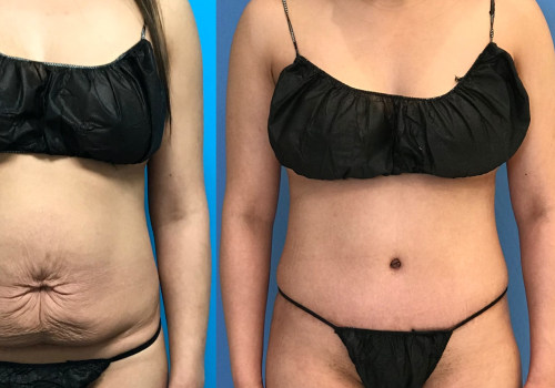 Liposuction vs Tummy Tuck: Which is More Painful?