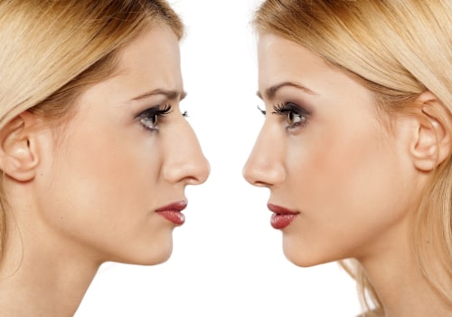 The Quickest Recovery Time for Plastic Surgery