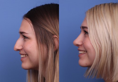 Mastering the Art of Rhinoplasty: The Complexities of the Most Difficult Plastic Surgery